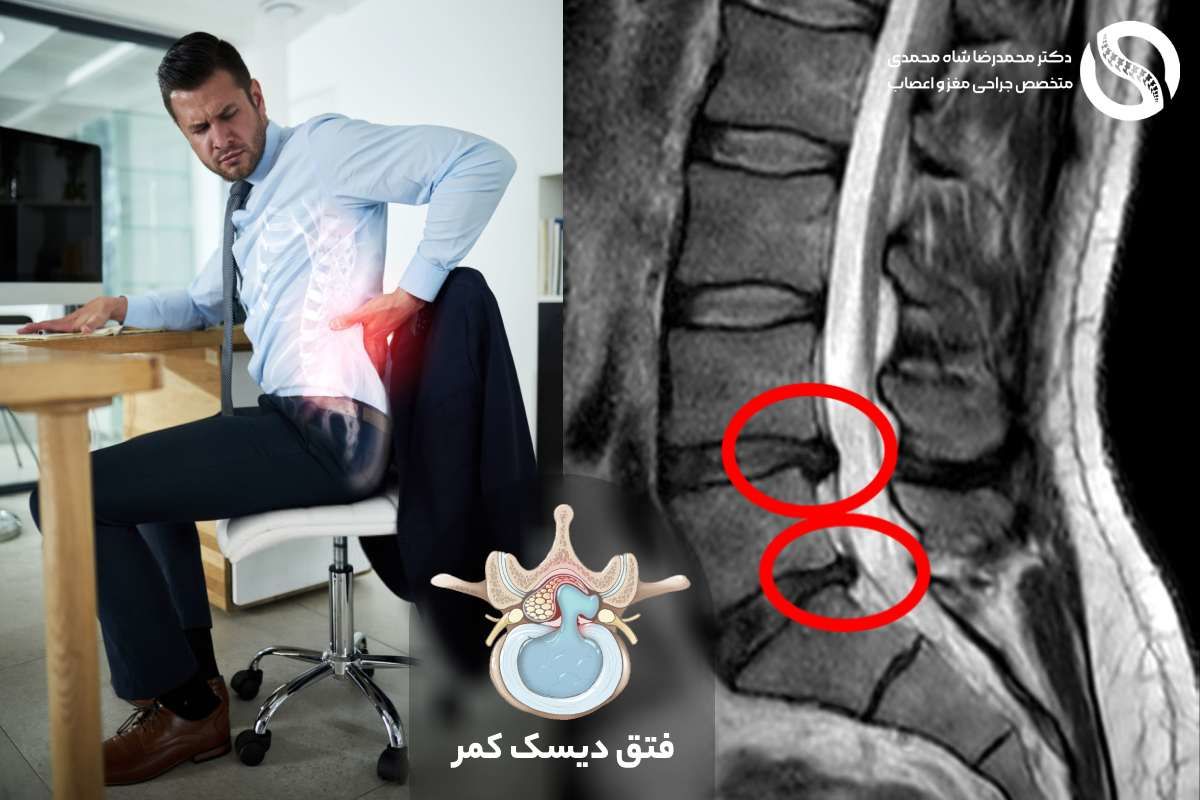 چگونه از دیسک کمر در کار اداری جلوگیری کنیم؟ علائم پنهان و پیشگیری مؤثر