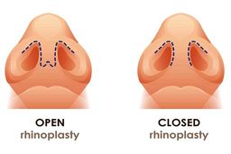 تفاوت جراحی بینی باز و بسته؛ جراحی بینی به روش بسته بهتر است یا باز؟